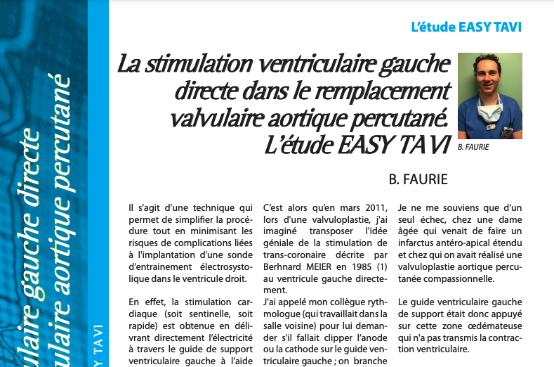 La stimulation ventriculaire gauche directe dans le remplacement valvulaire aortique percutané