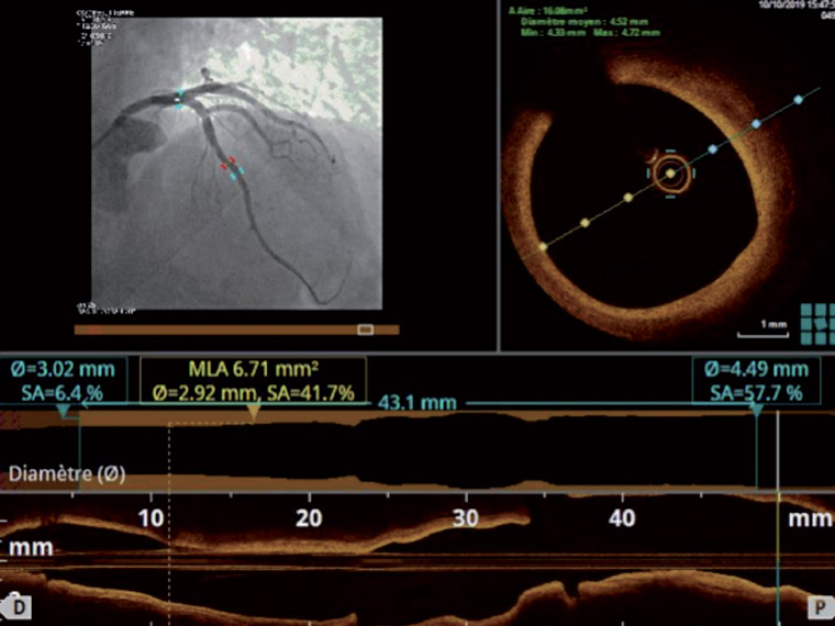 Dysfonction microcirculatoire